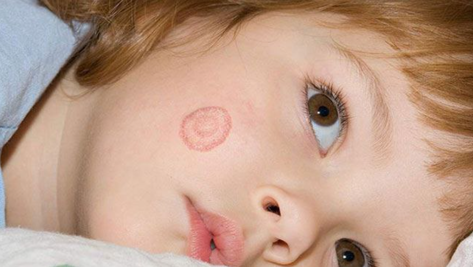 Rashes That Look Like Ringworm But Aren't
