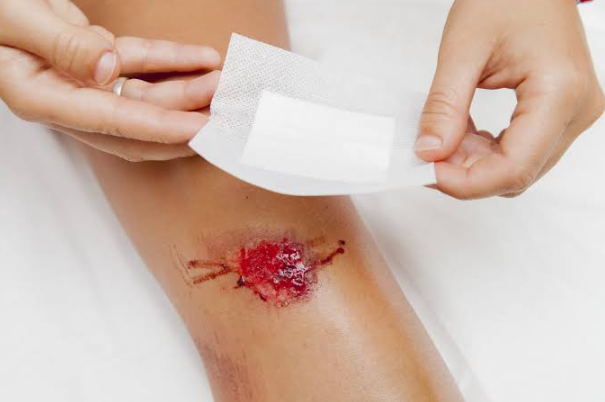 Practical Considerations for Managing Severe External Bleeding